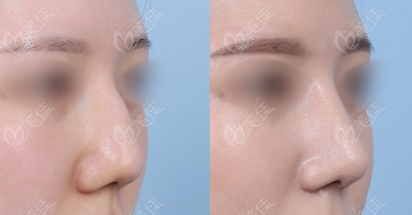花5万在韩国1mm整形外科做了驼峰鼻矫正和鼻综合，恢复后鼻子蛮好看的