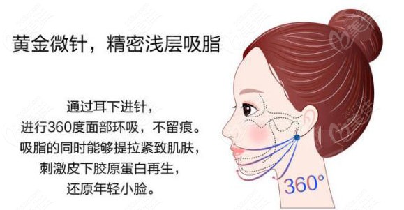 山西整形外科医院刘晋元院长做面部吸脂的优势