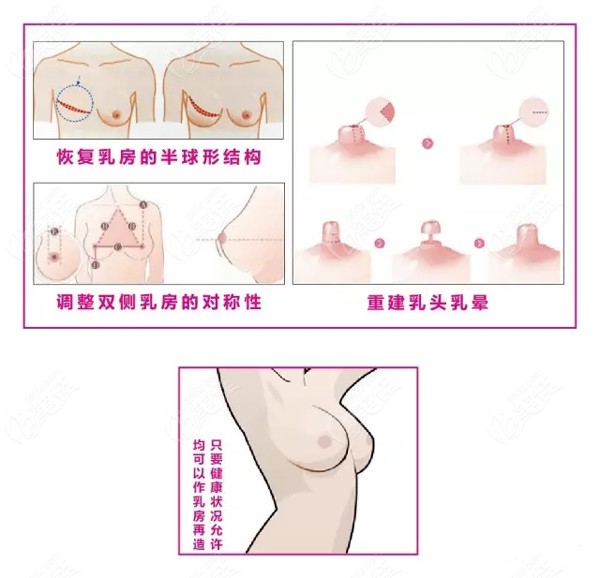 乳腺癌后胸再造的手术方法
