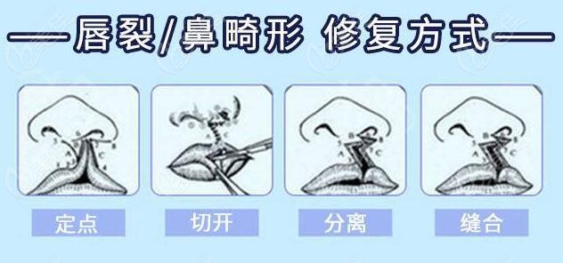唇裂鼻畸形的修复方式
