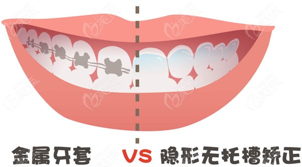 金属牙套和隐形牙套的区别图