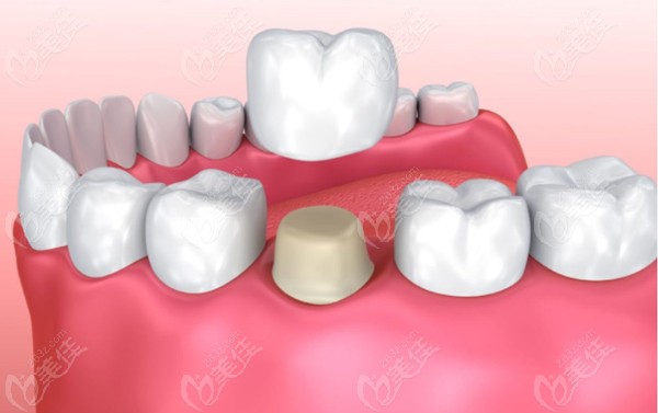 全瓷冠修复过程模拟图