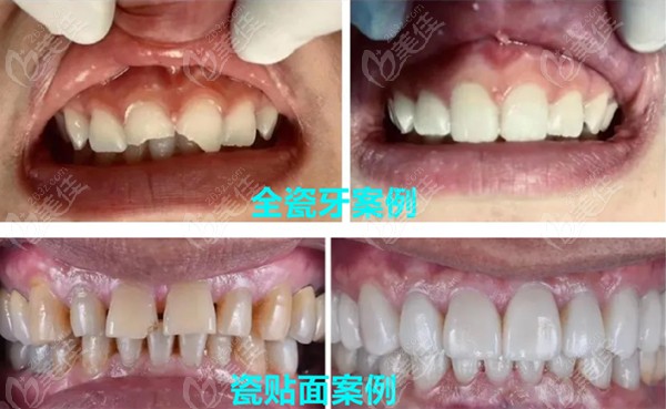 全瓷牙和瓷贴面的修复病例效果