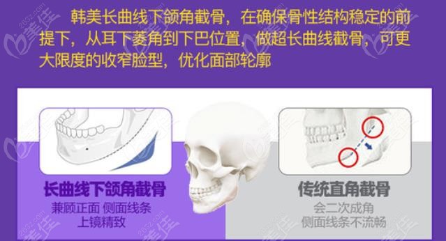 安徽韓美下頜角整形手術PK傳統(tǒng)直角截骨