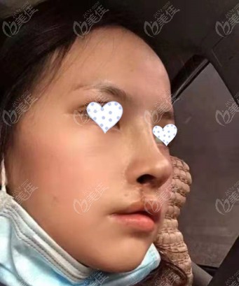 重庆美仑美奂毋巨龙做的唇腭裂+鼻修复前后照片，花费12万
