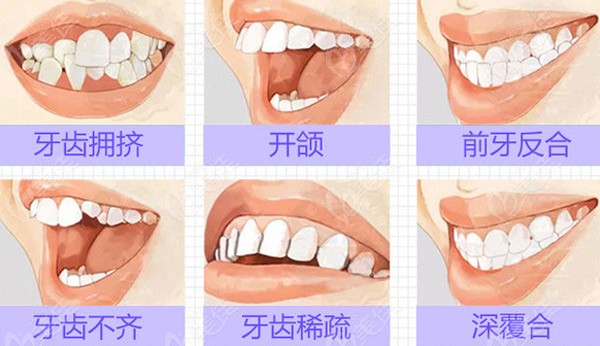 橋西口腔做牙齒矯正的價格是多少