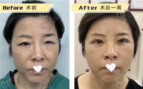 重庆美仑美奂董开云做的小切口面部提升效果图