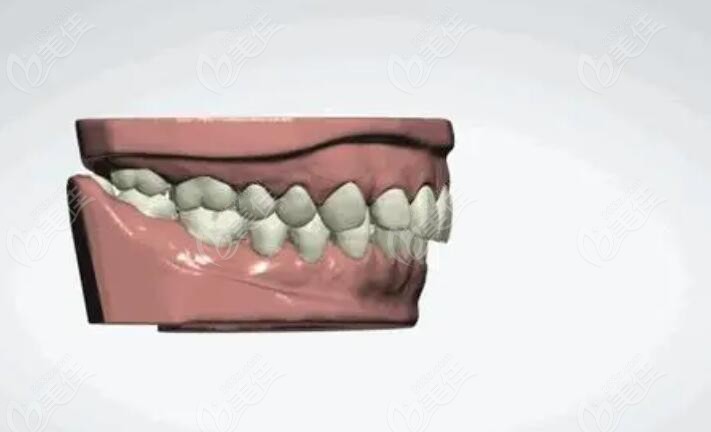 牙齿矫正3D数字化矫正