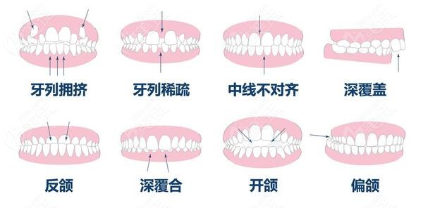 儿童牙齿畸形的症状有哪些？