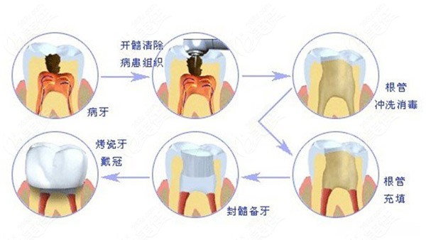 牙髓炎的治疗过程图