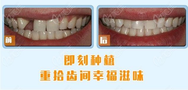 即拔即种种植牙