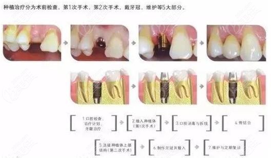 种植牙过程步骤