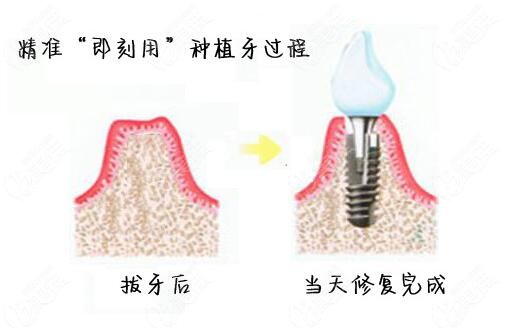 即拔即种种植牙需要几次才能完成这儿有标准流程及周期