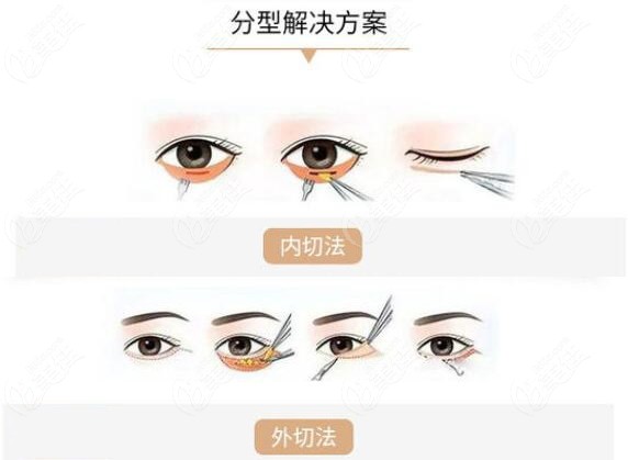 苏州美贝尔结合眼袋情况推出的其他去眼袋方法及费用
