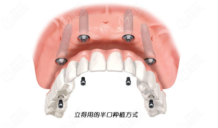 石家莊中諾口腔醫院種植牙如何先瞅瞅聶鑫醫生全口數字化種植技術吧