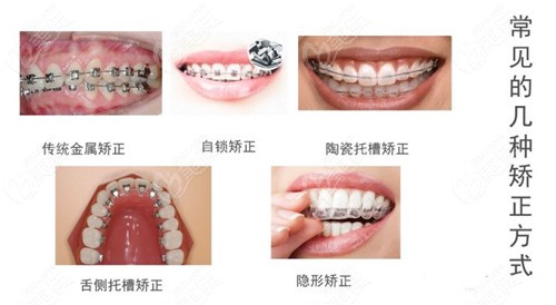 幾款常見的牙套外觀對比