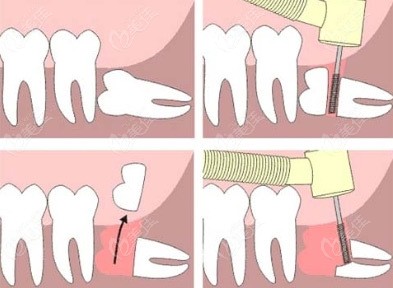 拔牙过程图解图片