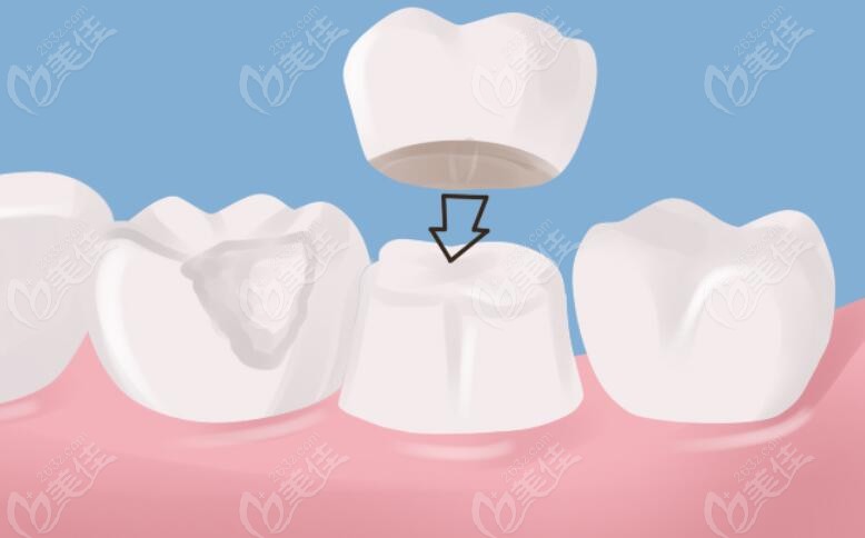 牙齿缺损时牙齿修复