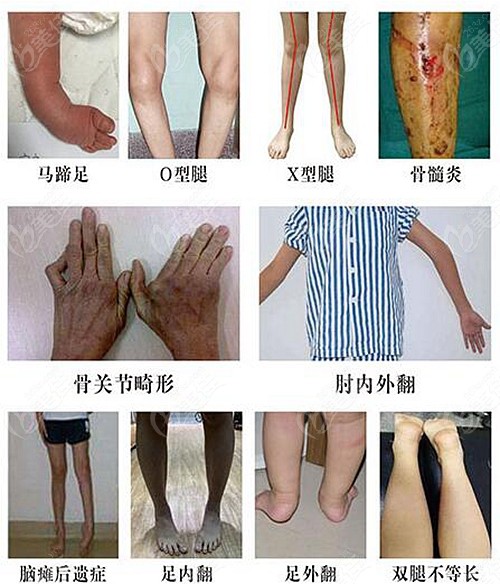 怕马蹄足治疗费用高自己承担不起来郑州中医一附院部分费用可减免