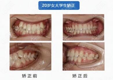 李薇薇医生病例展示：20岁牙齿不齐矫正