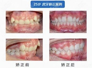 朱诤医生正畸病例对比图