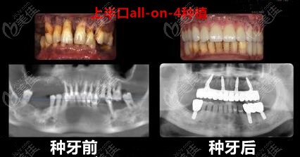 半口all-on-4技术
