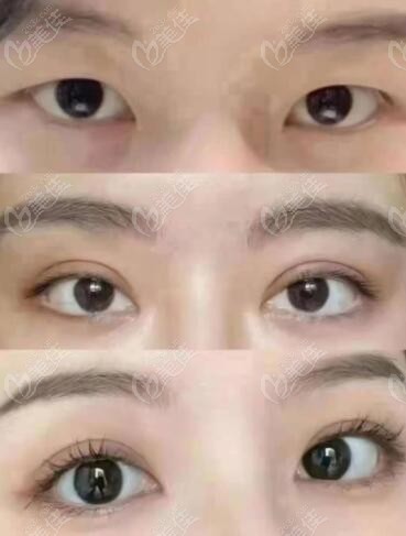 重庆恒美整形眼综合手术图