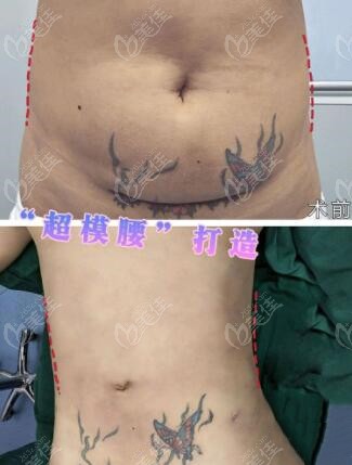 重庆恒美腰腹环吸手术图