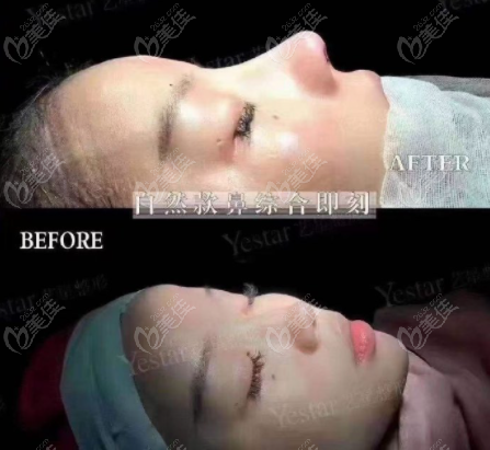 重庆恒美鼻综合对比图
