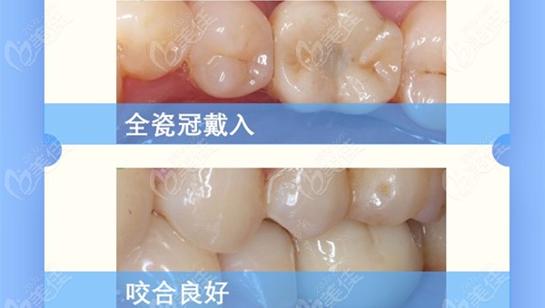 您觉得义乌傅氏口腔的种植牙效果好不好呢？欢迎评价这例下颌前磨牙种植病例