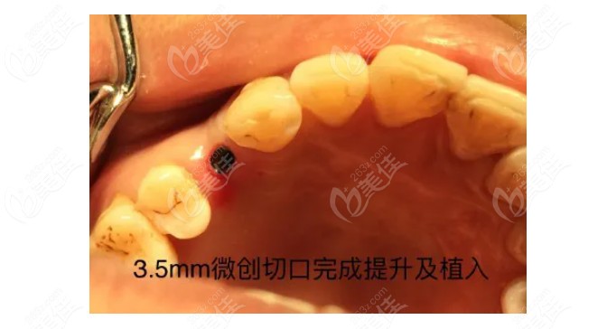 唐山牙博士为顾客做微创种植牙仅有3.5mm的切口