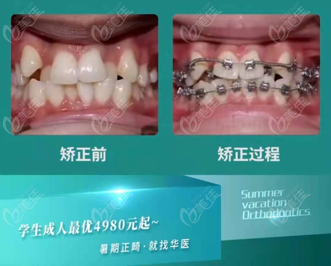 呼市华医口腔学生矫正价格