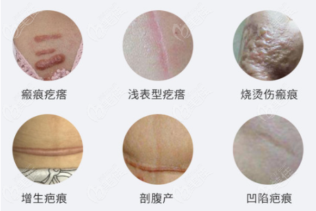 几种常见疤痕类型