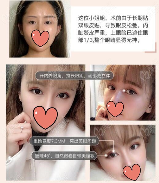 <i data-id='9f46452b-e35d-4ca4-8b3c-df495bbb68ae' style='display:none;'></i>眼綜合對比照