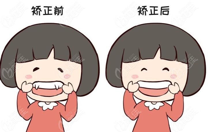 虎牙矫正前后的照片