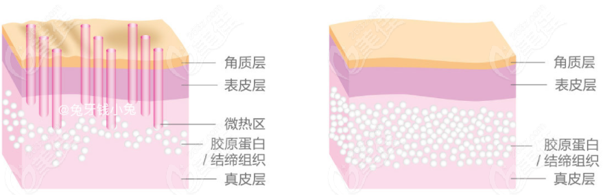 非剥脱点阵激光治疗原理