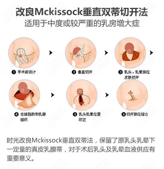 <!--<i data=20240703-sp></i>-->时光垂直双蒂切开法乳房缩小手术过程