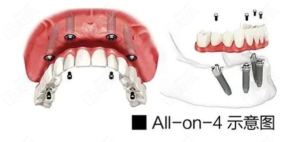 all- on-4种植牙技术优势