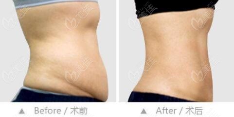 腹壁整形手术术前术后对比照