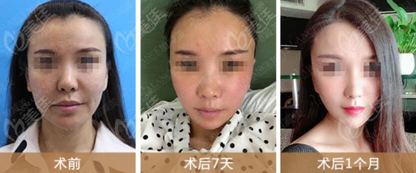 北京加减美v6提升面部真人实例