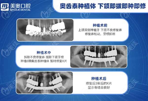 美奥口腔做的全口种植病例效果