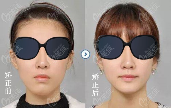 小白兔口腔许磊医生的矫正效果