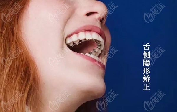 舌侧隐形矫正