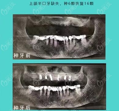 焦宏春：上半口all-on-6种植牙病例效果图