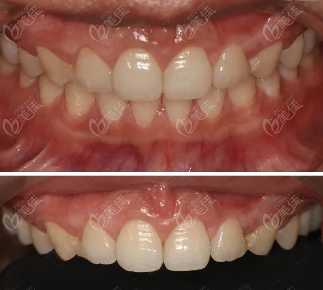 牙冠延长手术牙齿的变化
