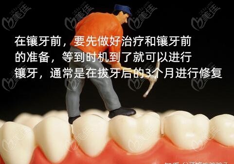  镶牙的准备
