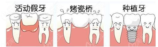 镶牙方式
