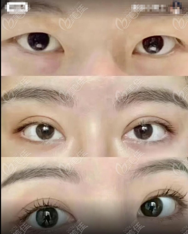 低眉骨做双眼皮的真人实例