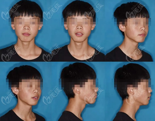 單側(cè)后牙反頜術前照片
