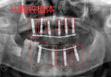 固定全口种植牙